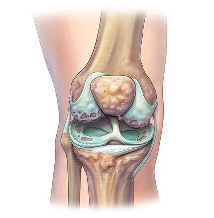 Destrucción de las articulaciones con el desarrollo de la osteocondrosis